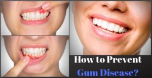 How to Prevent Gum Disease?