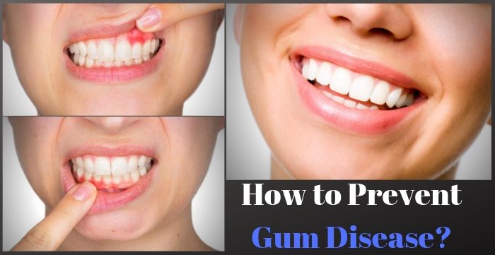 How to Prevent Gum Disease? How to Prevent Gum Disease?