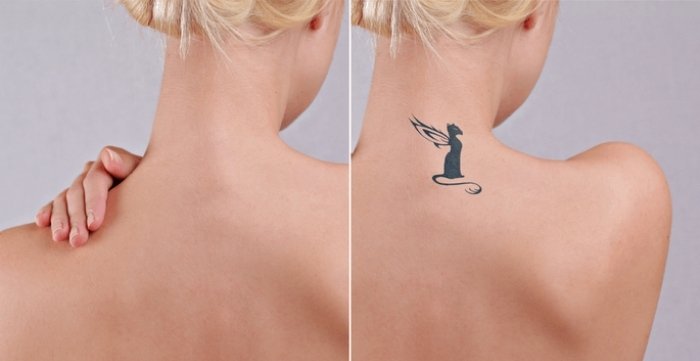 tattoo removal
