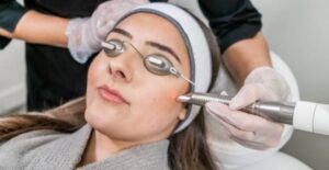 melasma laser treatment