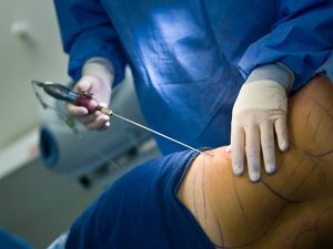 Understanding Liposuction